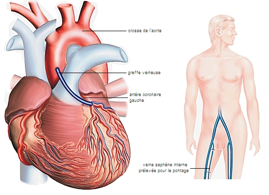 Technique du pontage aortocoronarien Technique du pontage aortocoronarien