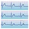 Électrocardiogramme Électrocardiogramme