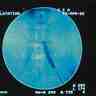 Angioplastie