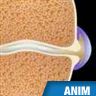 Arthrose